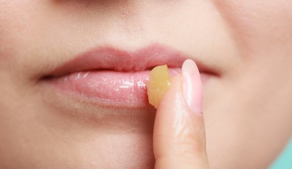 5 gjërat që buzët tuaja po përpiqen t’ju tregojnë për shëndetin
