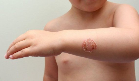 Sëmundja e lëkurës impetigo shfaqet për shkak të larjes në det të ndotur 