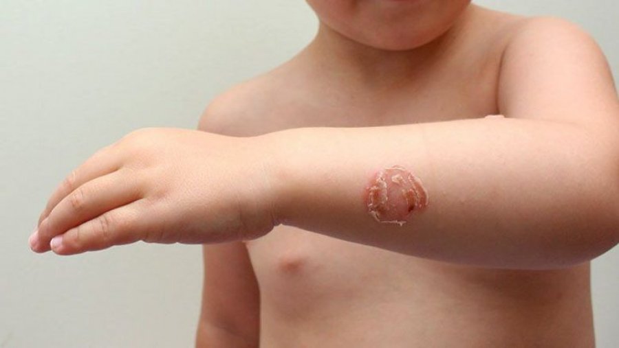 Sëmundja e lëkurës impetigo shfaqet për shkak të larjes në det të ndotur 