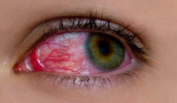 Sytë e kuq ju paralajmërojnë për sëmundjen e rëndë 