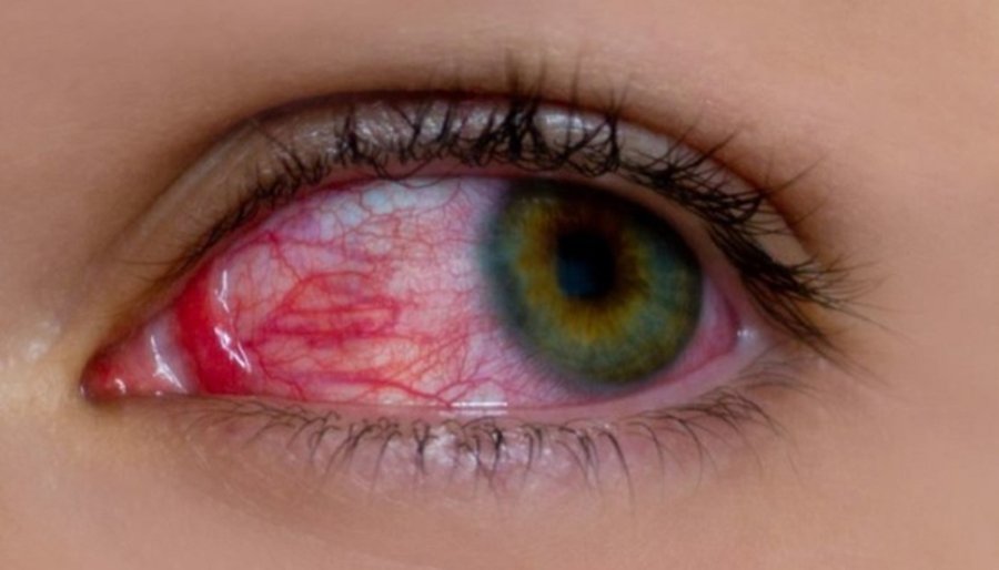 Sytë e kuq ju paralajmërojnë për sëmundjen e rëndë 