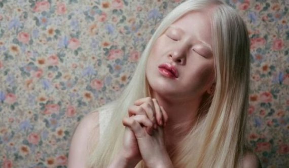 Historia e vajzës që e braktisën prindërit pse ishte albine, sot është modele e Vogue