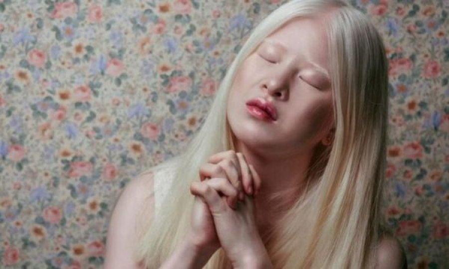 Historia e vajzës që e braktisën prindërit pse ishte albine, sot është modele e Vogue