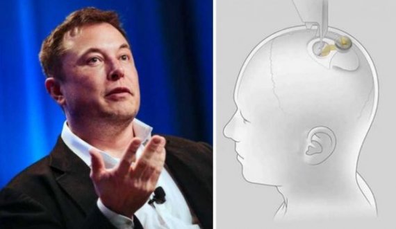 Musk do të nisë transplantimin e çipeve në trurin e njeriut në vitin 2022