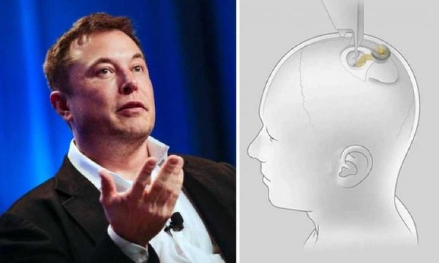 Musk do të nisë transplantimin e çipeve në trurin e njeriut në vitin 2022
