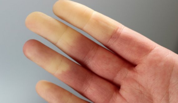 A keni dëgjuar për sindromën 'Raynaud'?