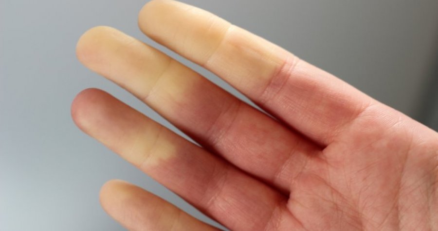 A keni dëgjuar për sindromën 'Raynaud'?