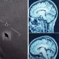 Simptomat e pazakonta të personave që mendohet se kanë takuar UFO-t