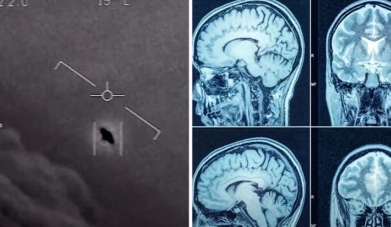 Simptomat e pazakonta të personave që mendohet se kanë takuar UFO-t