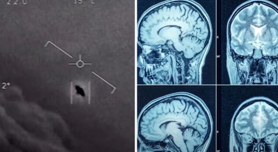 Simptomat e pazakonta të personave që mendohet se kanë takuar UFO-t