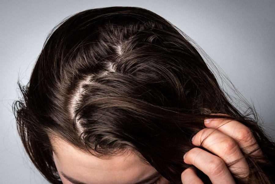 10 këshilla si të largoni një herë e mirë yndyrën nga flokët