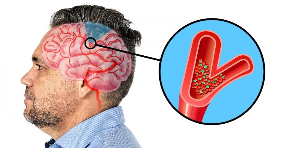 Çfarë duhet të dini rreth dhimbjes së kokës në anën e majtë