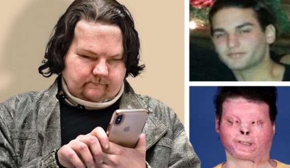 Transplanti i parë i fytyrës dhe duarve në botë i jep të riut një tjetër mundësi për të jetuar