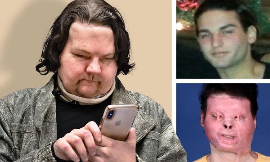 Transplanti i parë i fytyrës dhe duarve në botë i jep të riut një tjetër mundësi për të jetuar