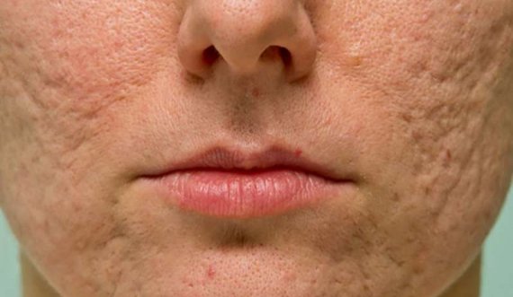 Trajtimi shtëpiak që pastron poret dhe freskon fytyrën