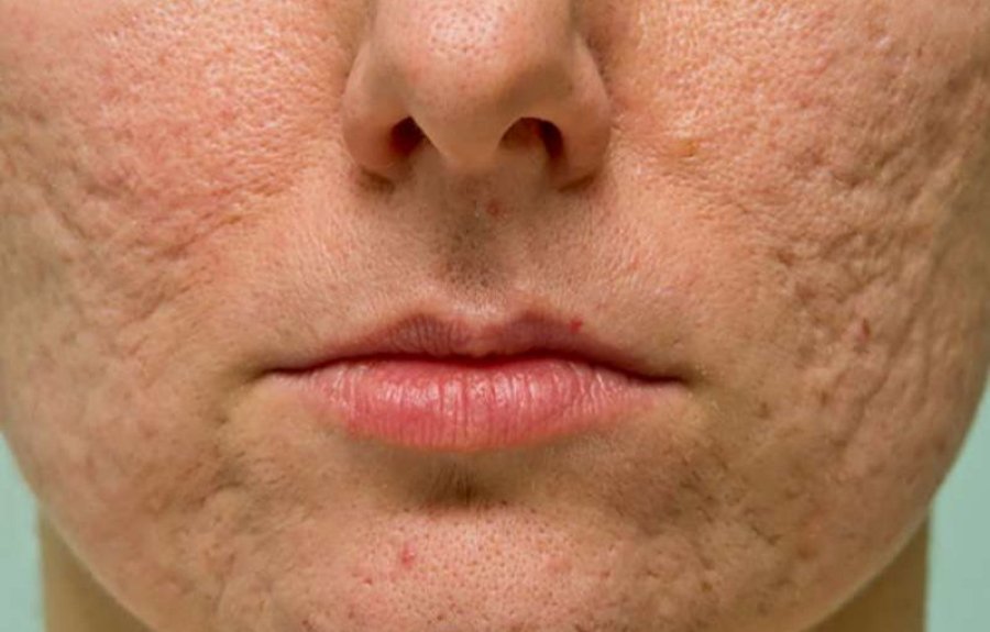 Trajtimi shtëpiak që pastron poret dhe freskon fytyrën