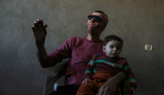 Palestinezi që iu dogj fytyra bëhet me maskë të prodhuar me printer 3D