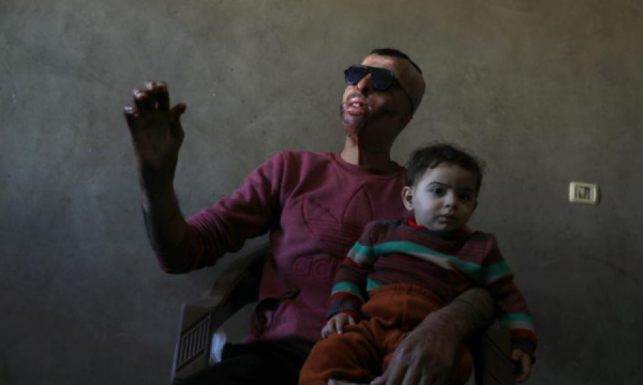 Palestinezi që iu dogj fytyra bëhet me maskë të prodhuar me printer 3D