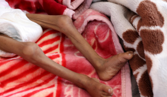 OKB-ja: Së paku 400.000 fëmijë të Jemenit mund të vdesin nga uria këtë vit