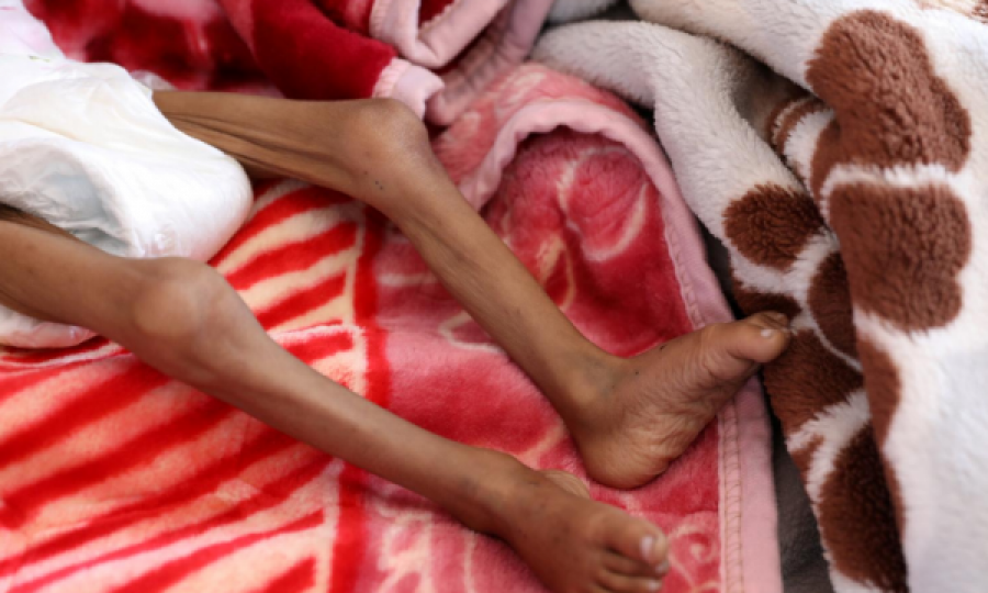 OKB-ja: Së paku 400.000 fëmijë të Jemenit mund të vdesin nga uria këtë vit