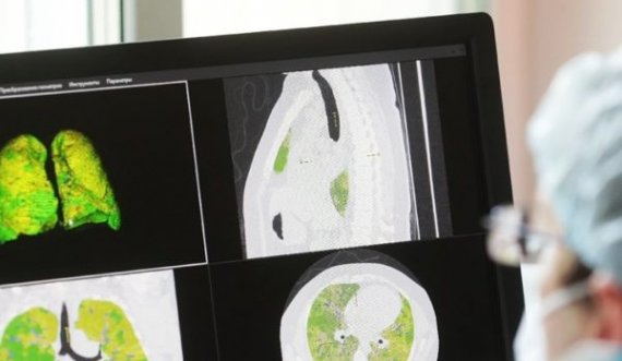 Gruaja vdes nga mushkëritë që iu dhuruan, ishin të infektuara me COVID-19