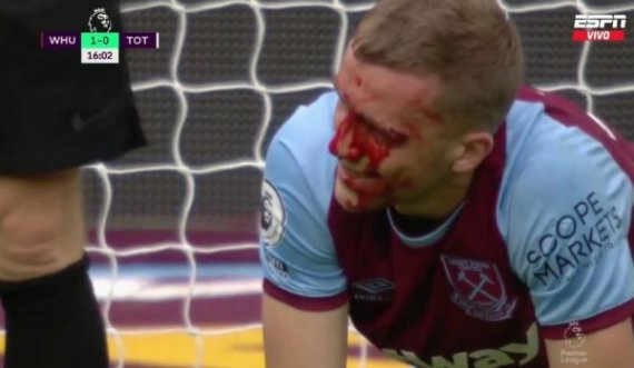 Përplasi kokën me kundërshtarin, gjakoset futbollisti i West Ham