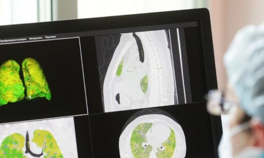 Gruaja vdes nga mushkëritë që iu dhuruan, ishin të infektuara me COVID-19