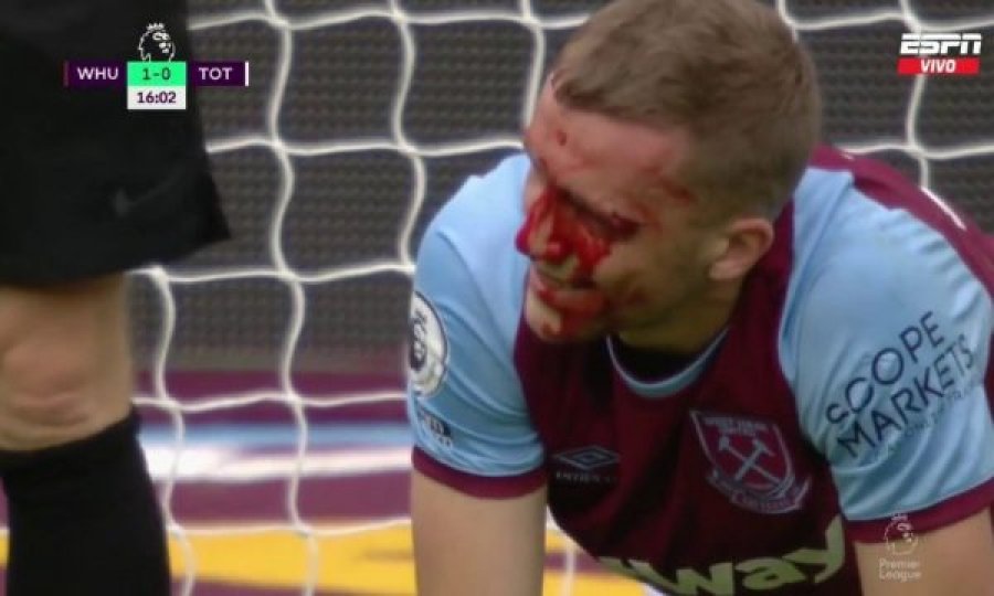 Përplasi kokën me kundërshtarin, gjakoset futbollisti i West Ham