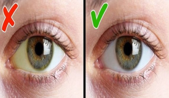 Keni mungesë të vitaminës D? Sytë tuaj i tregojnë simptomat kështu!