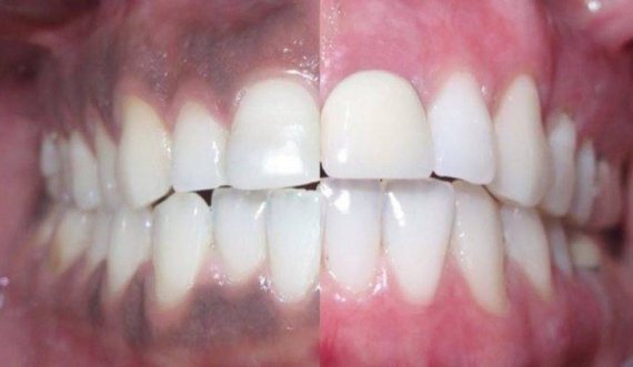 Problemet e shëndetit që fshihen pas mishrave të errët të dhëmbëve