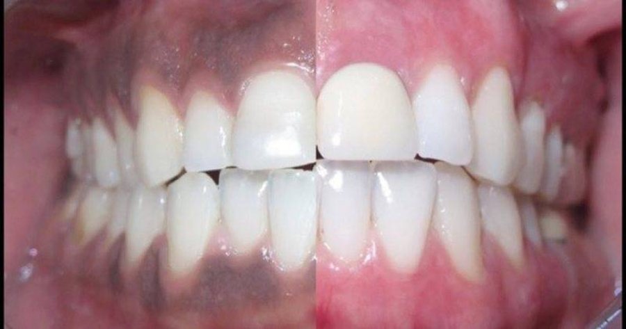 Problemet e shëndetit që fshihen pas mishrave të errët të dhëmbëve