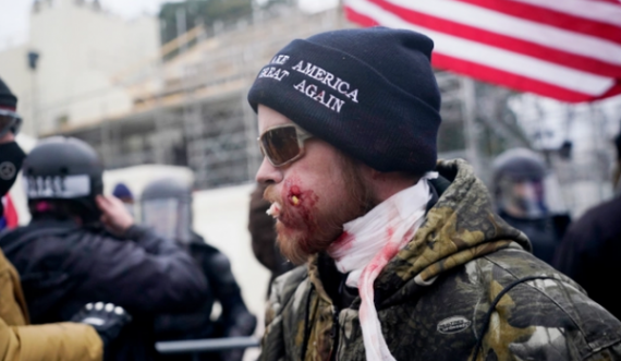 Me fasho të gjakosur dhe vrimë në faqe, fotoja e protestuesit në SHBA bëhet virale