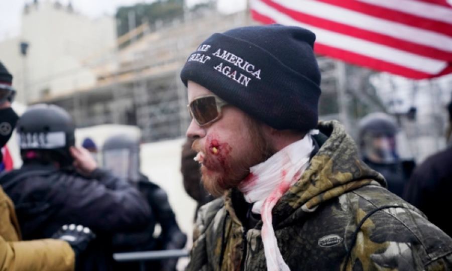 Me fasho të gjakosur dhe vrimë në faqe, fotoja e protestuesit në SHBA bëhet virale