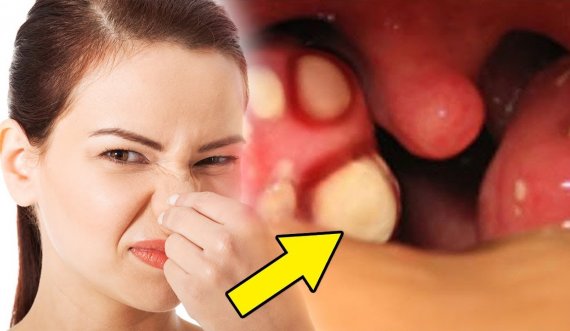 Tri mënyra të thjeshta kundër aromës së keqe të gojës 