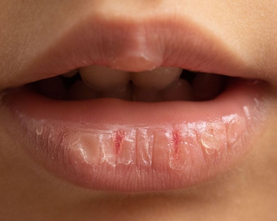 Ja çfarë u ndodh buzëve tuaja kur përdorni balsam shumë shpesh