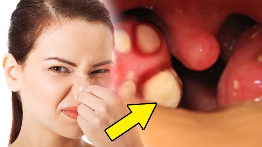 Tri mënyra të thjeshta kundër aromës së keqe të gojës 