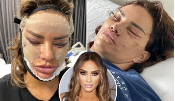 Katie Price zbulon operacionin brutal estetik