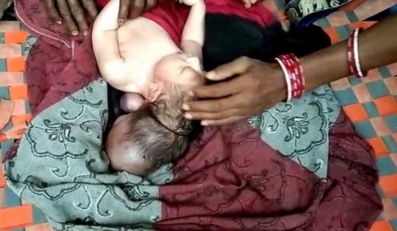 Lind në Indi “foshnja me tre koka”, konsiderohet nga njerëzit si mishërimi i Zotit
