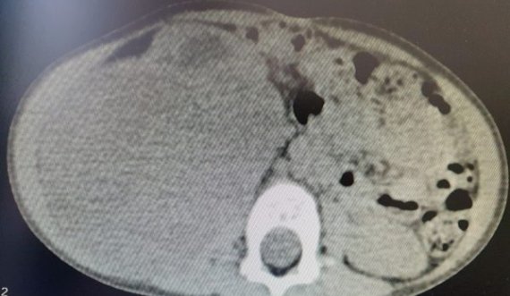 2-vjeçarit në QKUK i hiqet tumori që i kishte përfshirë gjysmën e barkut