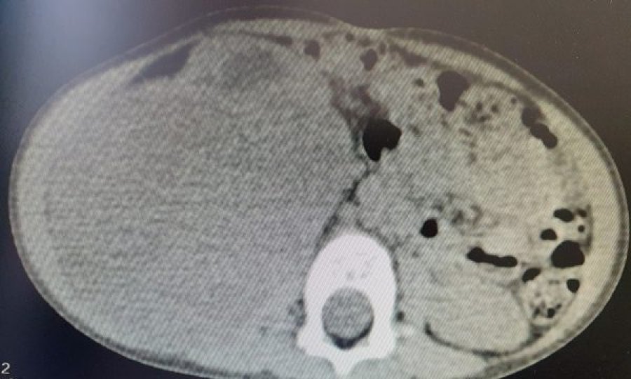 2-vjeçarit në QKUK i hiqet tumori që i kishte përfshirë gjysmën e barkut