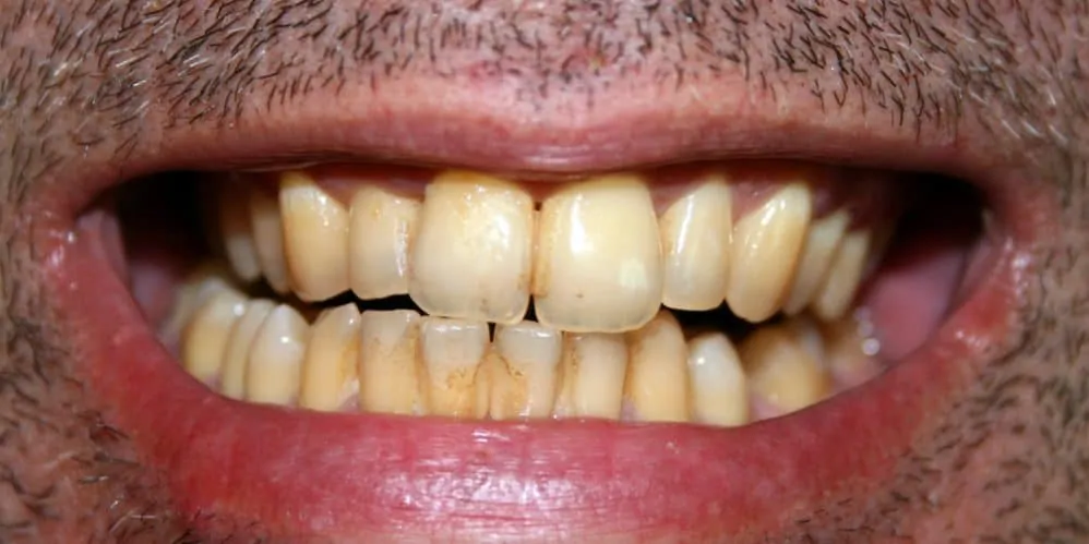  Shtatë zakone të përditshme i dëmtojnë dhe zverdhin dhëmbët 