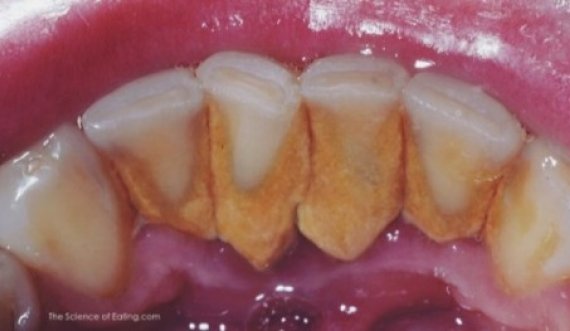 Këshilla për heqjen dhe parandalimin e grumbullimit të gurëve në dhëmbë