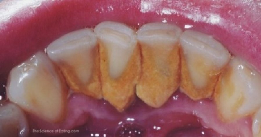 Këshilla për heqjen dhe parandalimin e grumbullimit të gurëve në dhëmbë