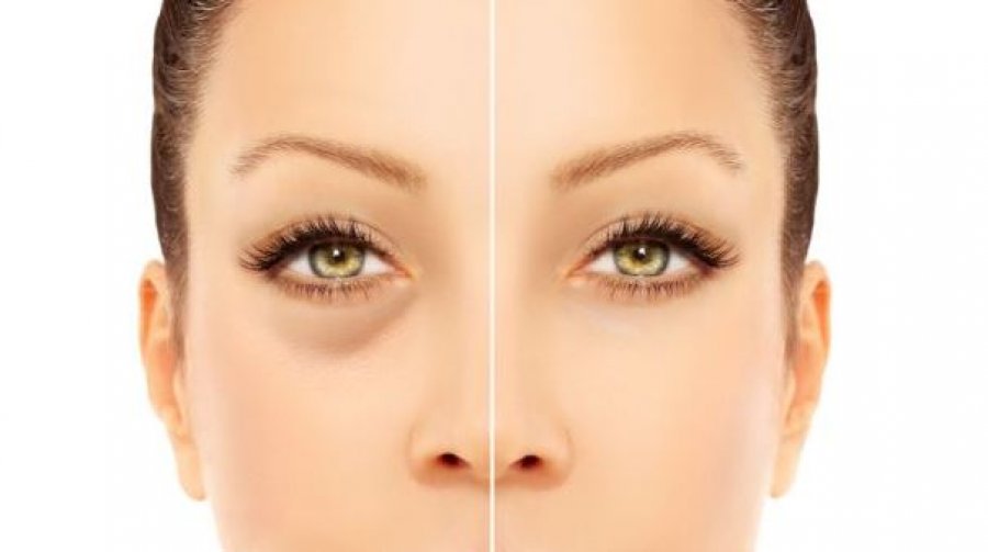 5 trajtimet e panjohura që duhet t’i provoni sa më parë nëse vuani nga rrathët e errët nën sy