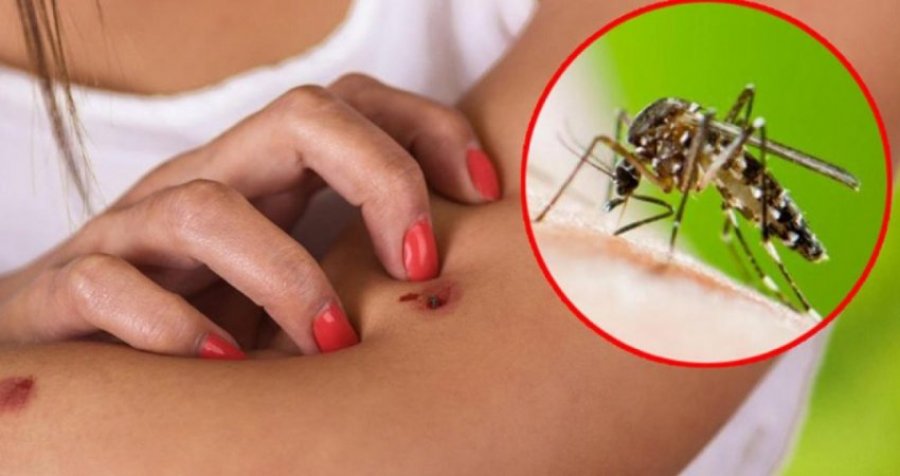 Mënyrat për të lehtësuar pickimet e mushkonjave për 1 sekondë 