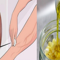Edhe mjekët janë mahnitur nga rezultati i saj, kjo është receta që eliminon variçet brenda 1 muaji