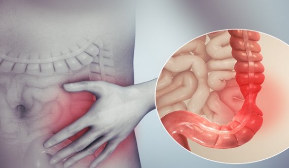 Ushqimet më të mira për zbutjen e simptomave të sëmundjes së Crohn-it