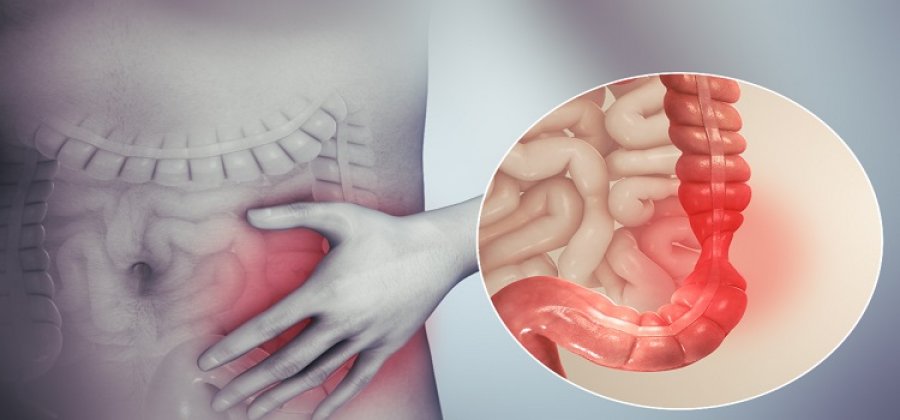 Ushqimet më të mira për zbutjen e simptomave të sëmundjes së Crohn-it