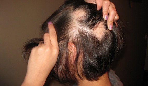 Mënyra natyrale për trajtim të rënies së flokëve