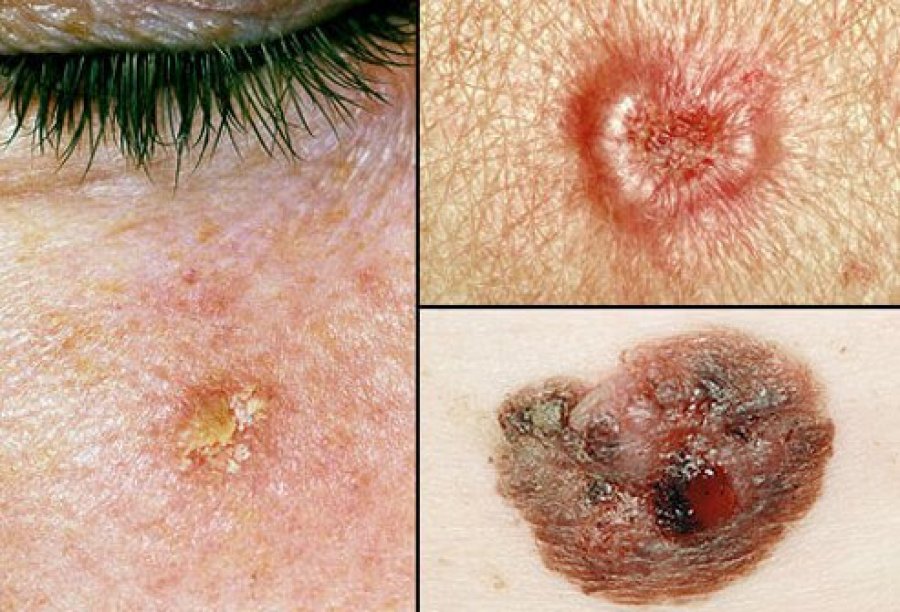 Simptomat e kancerit të lëkurës: Pesë shenja paralajmëruese 